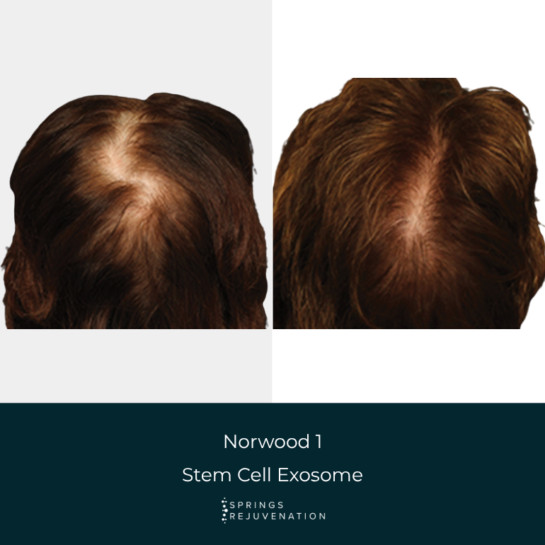 Norwood 1 Stem Cell Exosome